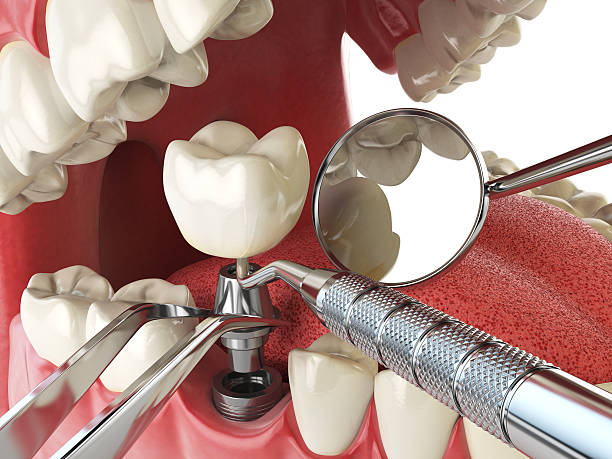 Best Emergency Wisdom Teeth Removal in Fort Oglethorpe, GA